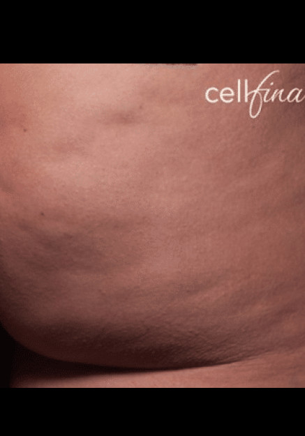 Cellfina – Case 6