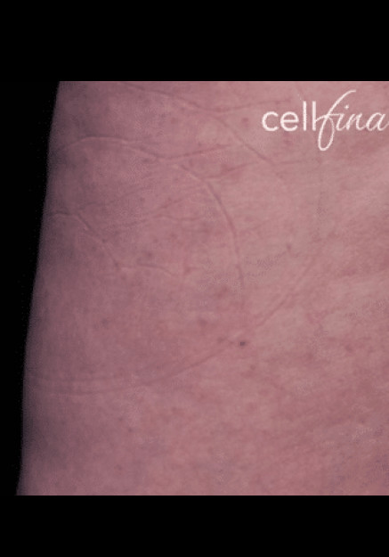 Cellfina – Case 9