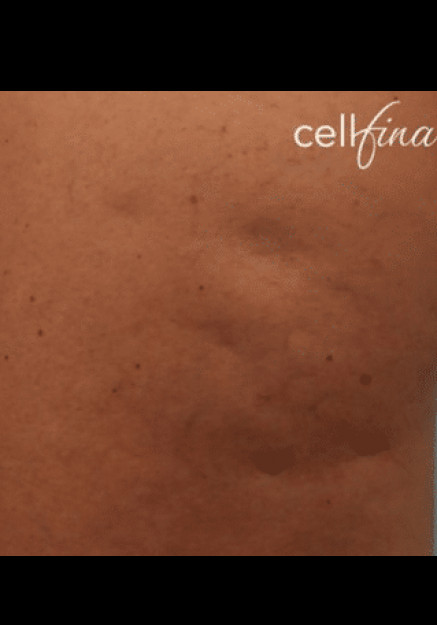 Cellfina – Case 10