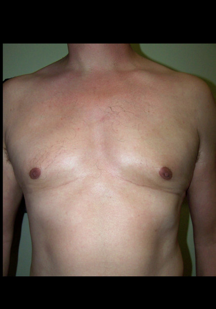 Male Breast Reduction – Case 2