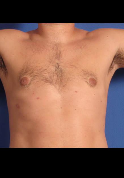 Male Breast Reduction – Case 4