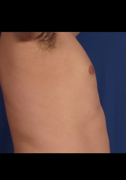 Male Breast Reduction – Case 4