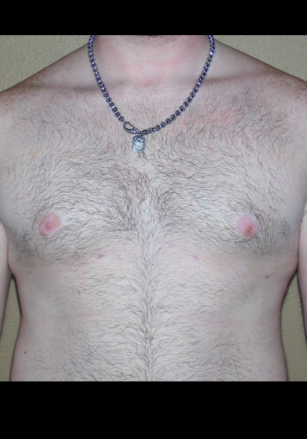 Male Breast Reduction – Case 5