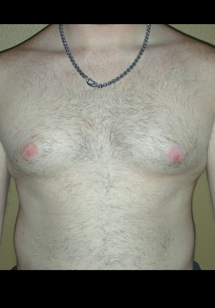Male Breast Reduction – Case 5