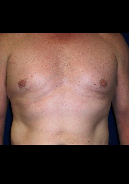 Male Breast Reduction – Case 6