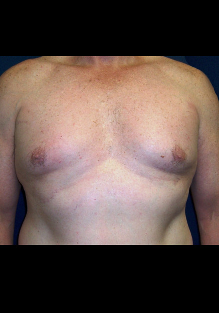 Male Breast Reduction – Case 6