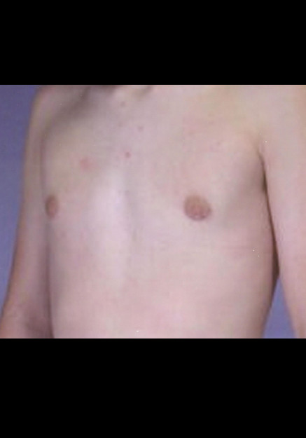 Male Breast Reduction – Case 8