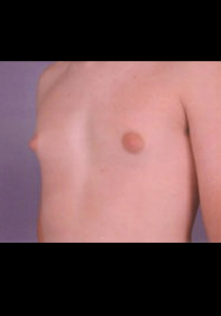 Male Breast Reduction – Case 8
