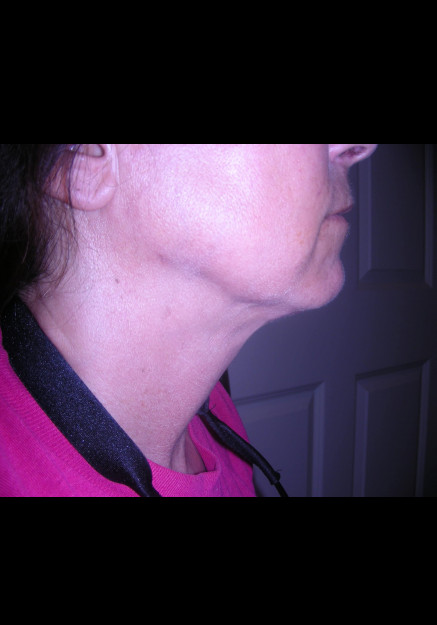 VASER Liposuction of Neck and Double Chin