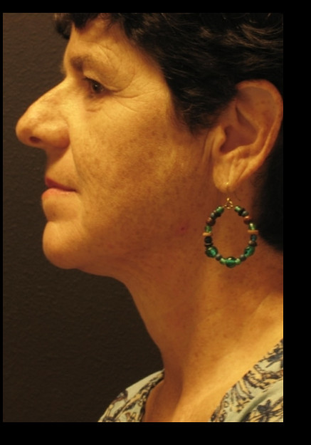 VASER Liposuction of Neck and Double Chin