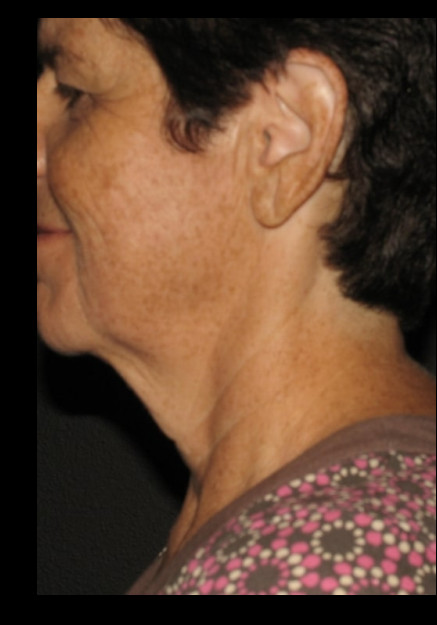 VASER Liposuction of Neck and Double Chin