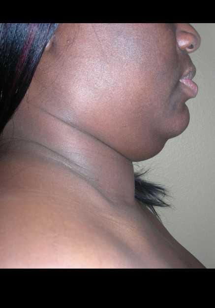 VASER Liposuction Neck and Double Chin