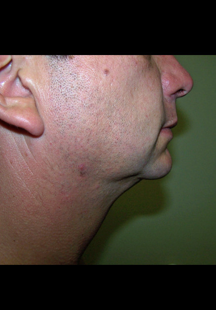 VASER Liposuction of Neck and Double Chin
