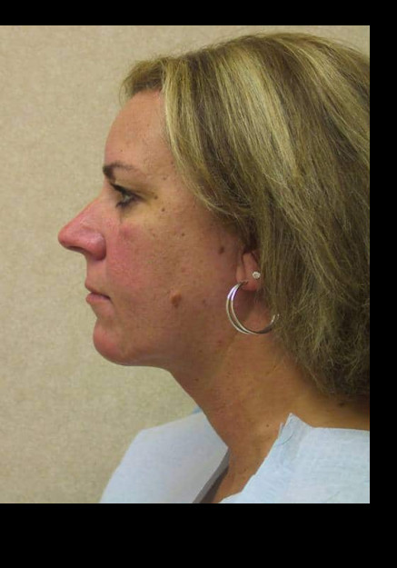 VASER Liposuction of the Neck and Double Chin