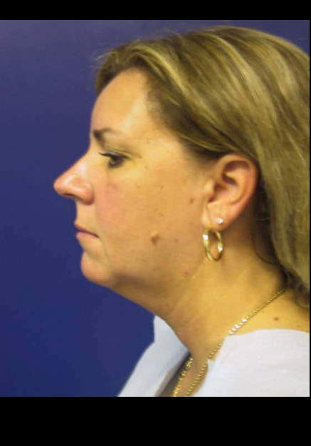Before Image: VASER Liposuction of the Neck and Double Chin