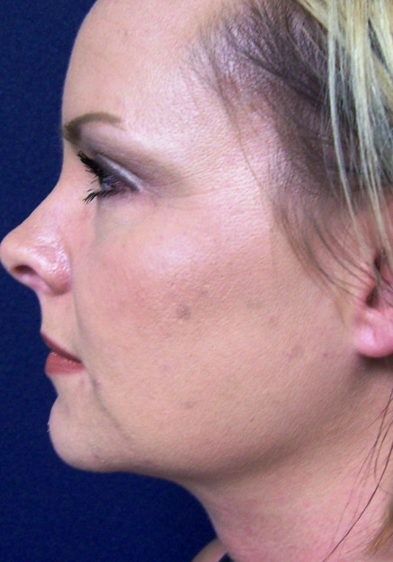 VASER Liposuction of Neck and Double Chin