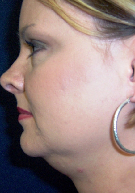 VASER Liposuction of Neck and Double Chin