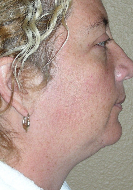 VASER Liposuction of Neck and Double Chin
