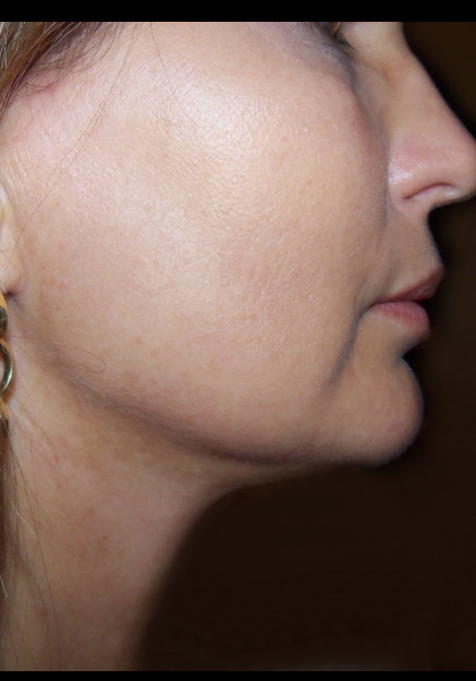 VASER Liposuction of Neck and Double Chin