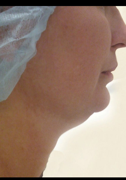 VASER Liposuction of Neck and Double Chin