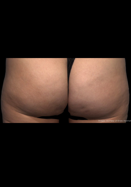 Qwo Cellulite Injections