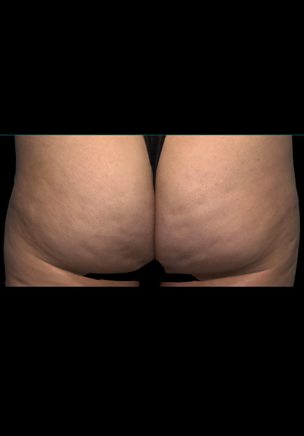 Qwo Cellulite Injections