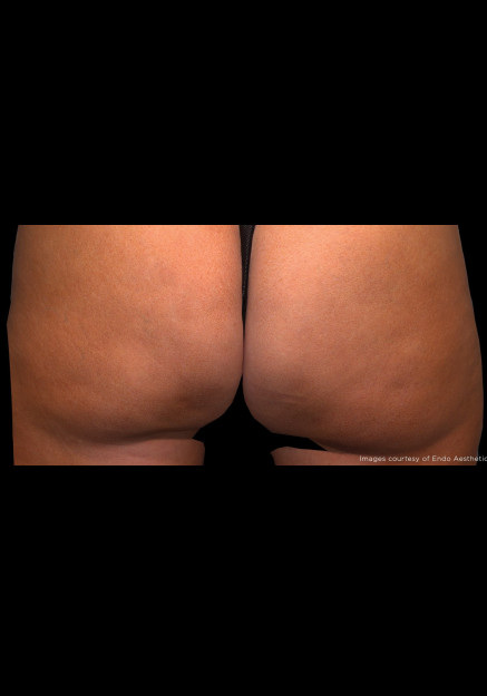 Qwo Cellulite Injections