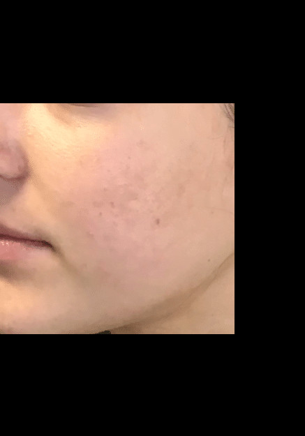 Skin Pen Microneedling