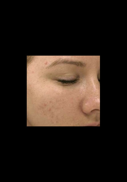 Skin Pen Microneedling