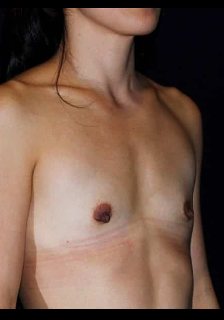 Breast Augmentation – Case 23