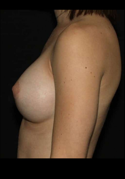 Breast Augmentation – Case 27
